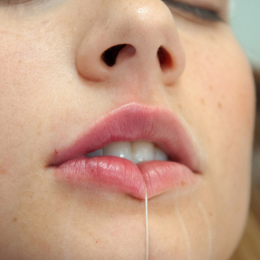 Tratamiento de labios